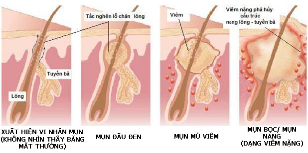 vi sao mun de lai vet tham