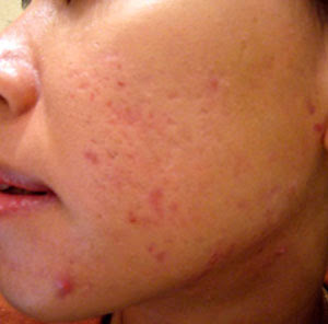 Sẹo mụn