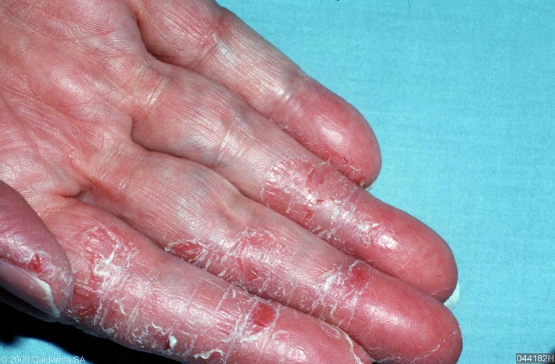Irritant Contact Dermatitis Hand 