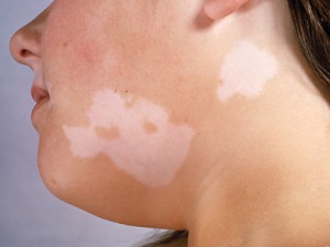 vitiligo-face