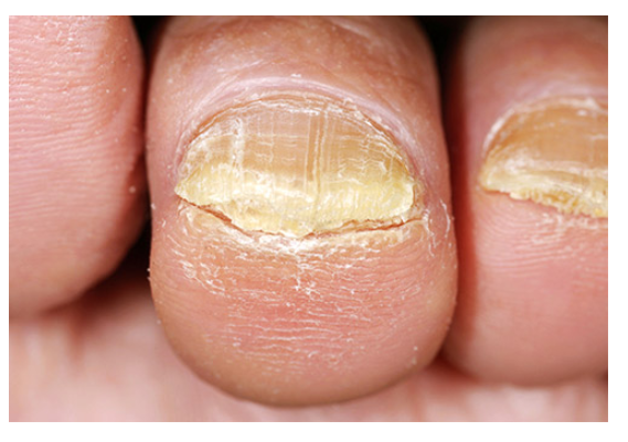How to get rid of nail fungus | Edward-Elmhurst Health