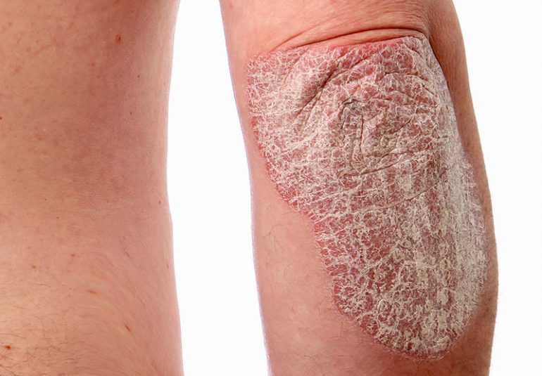 Tips to Manage Your Psoriasis Triggers - Stamford Skin Centre