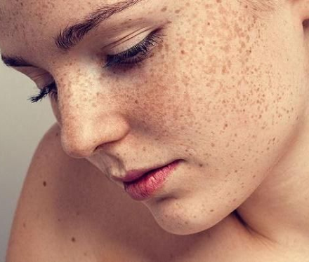 Freckles - Melasma