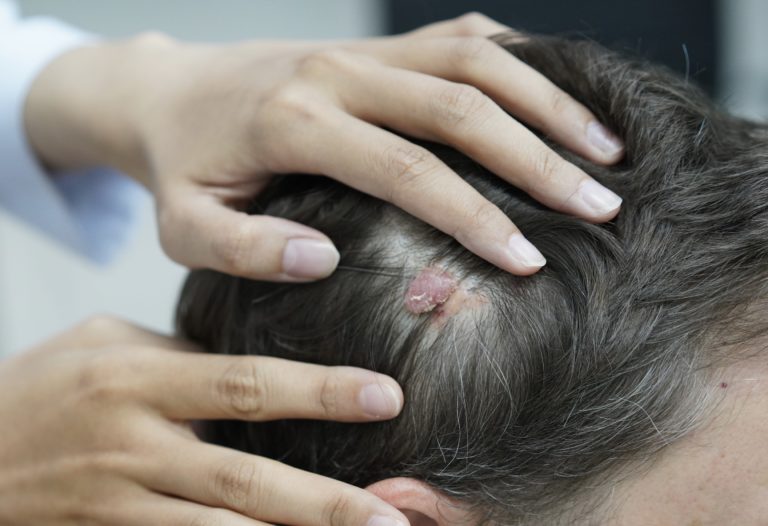 Sebaceous Birthmark SEBACEOUS NEVUS