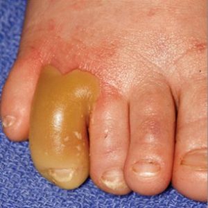 BLISTERING DISTAL DACTYLITIS - Stamford Skin Centre