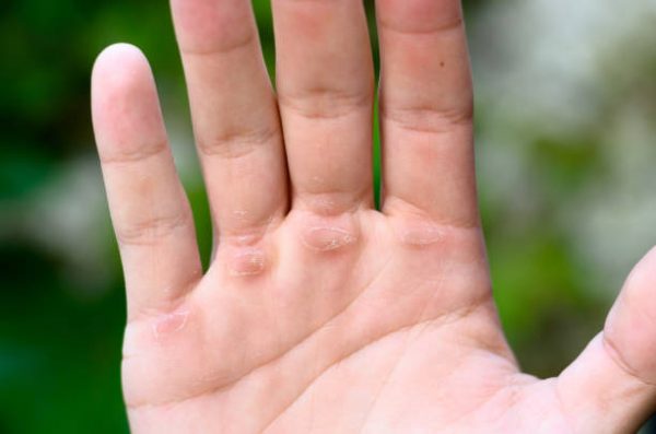 calluses-stamford-skin-centre