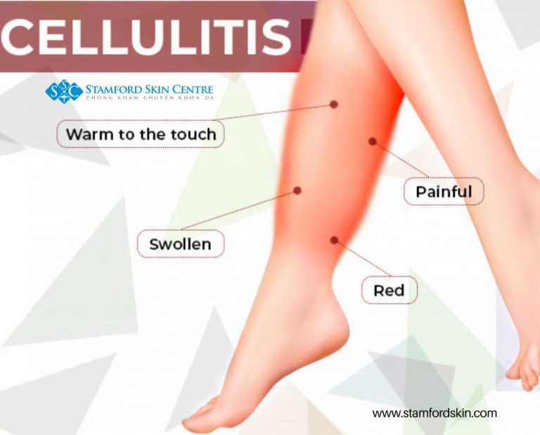Skin. Cellulitis Background CELLULITIS - Stamford Skin Centre