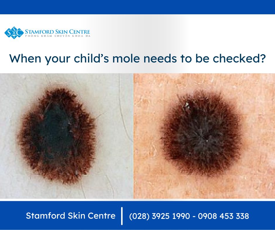 WHEN YOUR CHILD'S MOLE NEEDS TO BE CHECKED? - Stamford Skin Centre