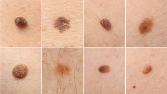 Mole Development WHEN YOUR CHILD'S MOLE NEEDS TO BE CHECKED? - Stamford Skin Centre