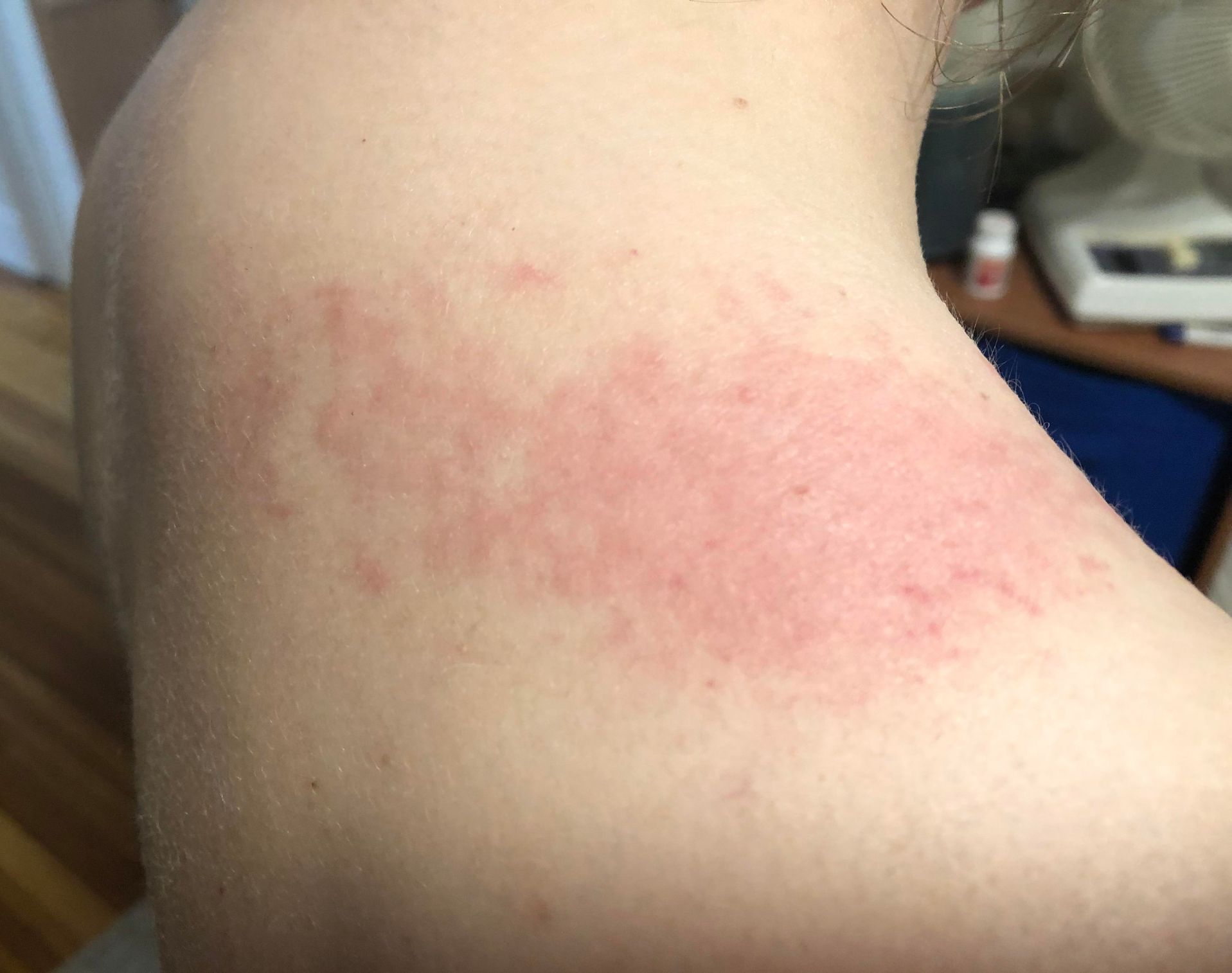 Polymorphic light eruption - Stamford Skin Centre