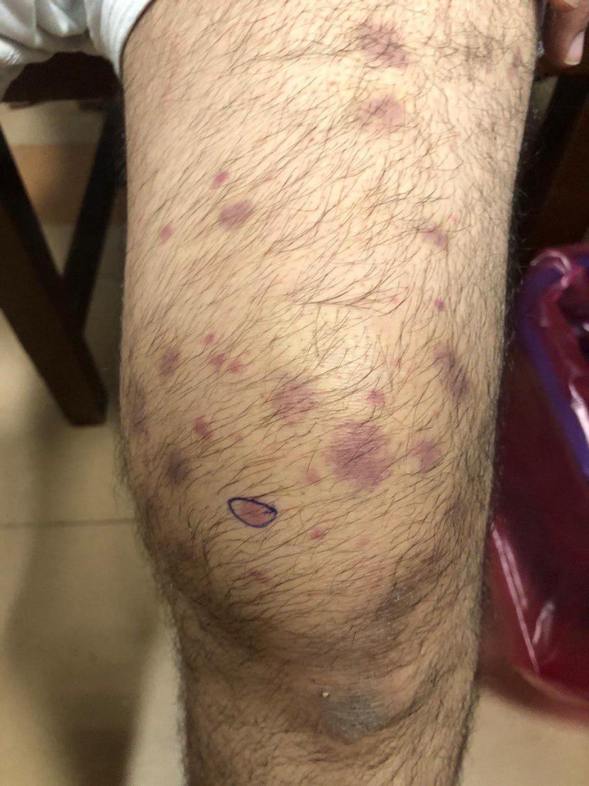 Anti-Neutrophil cytoplasmic antibody (ANCA) associated vasculitis ...