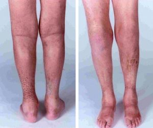Xơ hóa hệ thống nguồn gốc thận – Nephrogenic systemic fibrosis