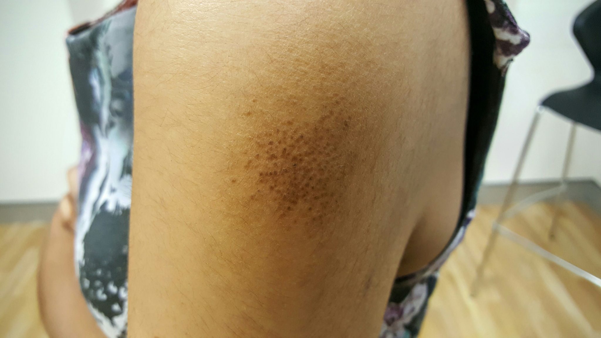 Amyloidosis - Stamford Skin Centre