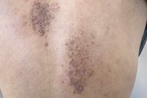 Bệnh thoái hóa tinh bột – Amyloidosis