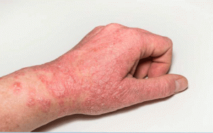 Hội chứng Carcinoid