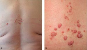 Những loại u xơ thần kinh ít gặp hơn