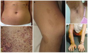 Neurofibromatosis type 1 | Bệnh Von Recklinghausen