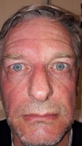 Rối loạn chức năng tự chủ và da