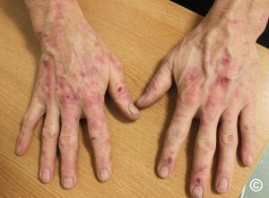 Porphyria