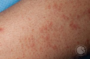 Bệnh ghép chống vật chủ cấp tính ở da
