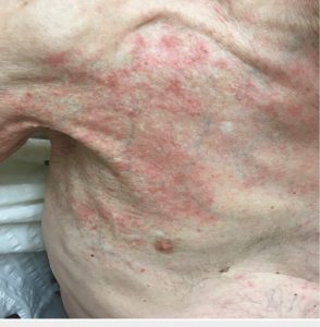 Những ảnh hưởng trên da từ xạ trị