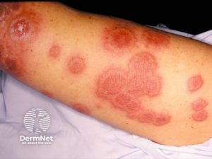 Neutrophilic dermatoses