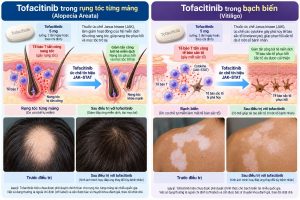 TOFACITINIB: CÁC CHỈ ĐỊNH ĐIỀU TRỊ HIỆN NAY